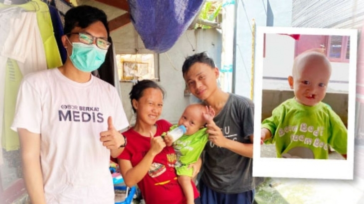 Kesaksian OBI: Operasi Bibir Sumbing buat Fatih Lewat Program Life Changing Surgeries