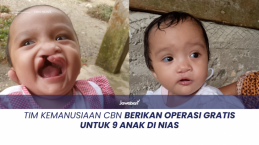 Tim Kemanusiaan CBN Berikan Operasi Gratis untuk 9 Anak di Nias