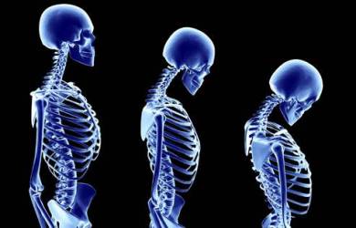 Kenali Tanda Osteoporosis Sejak Sekarang