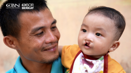 OBI Bantu 7 Anak di Nias Jalani Operasi Bibir Sumbing Gratis