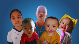 10 Anak di Nias Akan Operasi Bibir Sumbing!