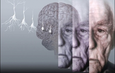 Penderita Alzheimer Dapat Pertajam Daya Ingat Dengan Ini