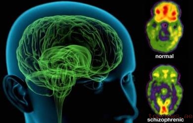 Hubungan Schizophrenia dengan Primanya Tubuh