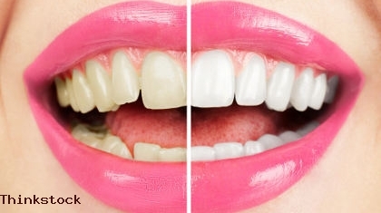 Tren Veneer Gigi yang Bikin Lebih Cantik dan Pede
