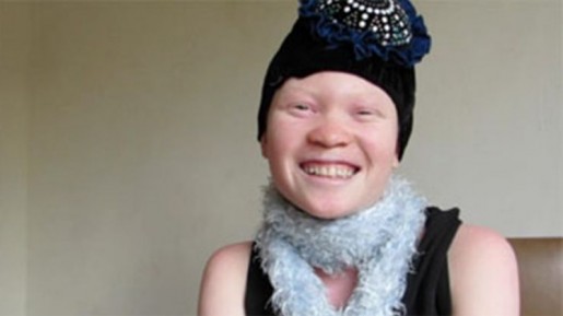 Ditolak Karena Albino Justru Hantar Gadis Afrika Ini Jadi Berkat Bagi Orang Lain