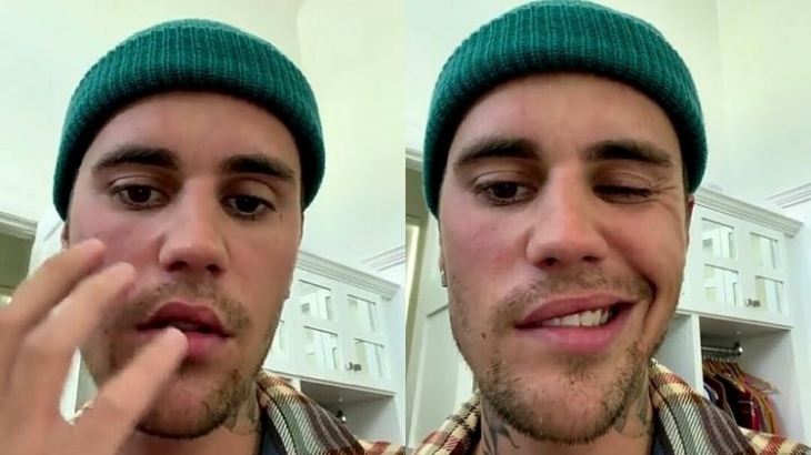 4 Fakta Lumpuhnya Separuh Wajah Justin Bieber, Salah Satunya Percaya Ada Rencana Tuhan