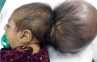 Bayi Perempuan Afghanistan Ini Lahir Dengan Dua Kepala